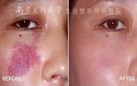 南京祛鲜红斑痣